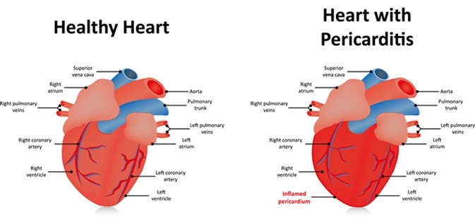 Tratamiento De La Pericarditis [ 308 x 673 Pixel ]