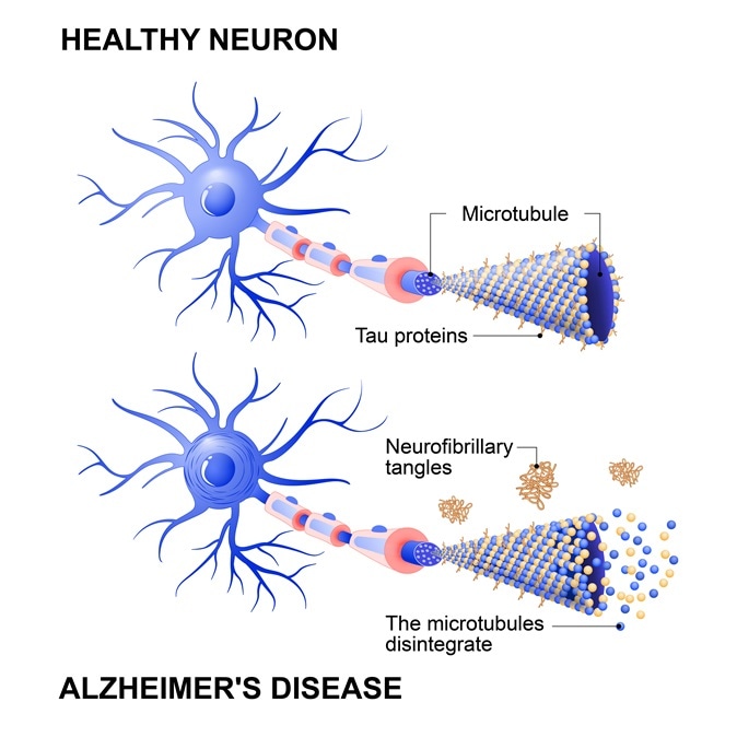 Neurona normal y neurona afectada por alzheimer. Ciencia desarrolla tecnología para combatir la enfermedad que afecta la memoria