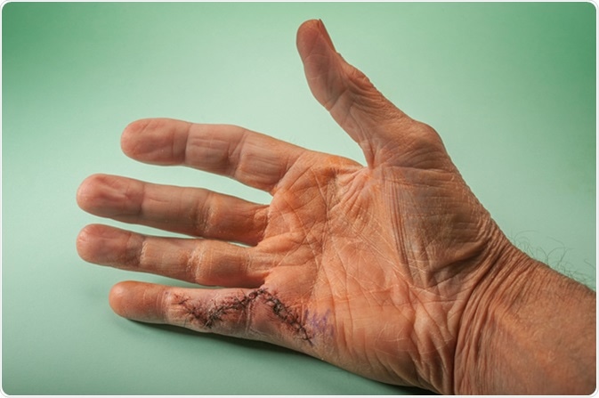 de ce doare articulația antebrațului mâinile rănesc articulațiile
