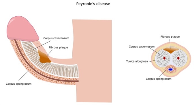 Prostatitis és peyroni- betegség