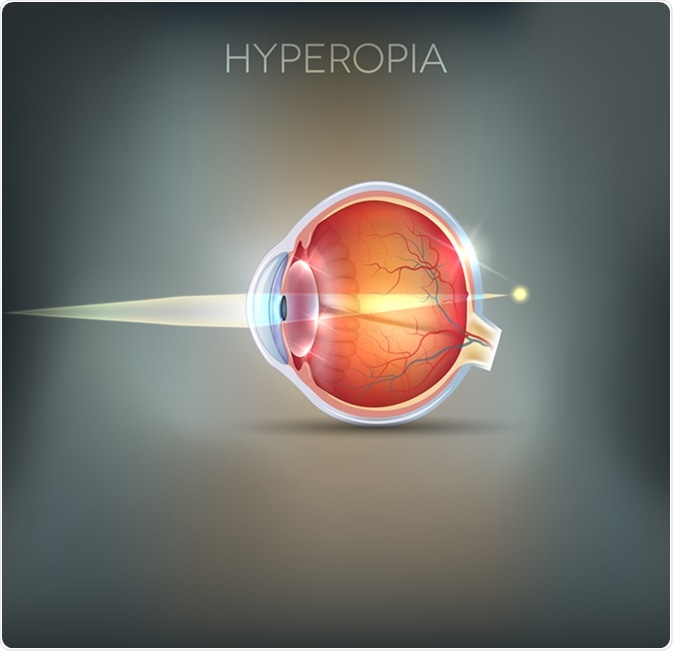 hyperopia és diplopia látás a mínusz 2-nél