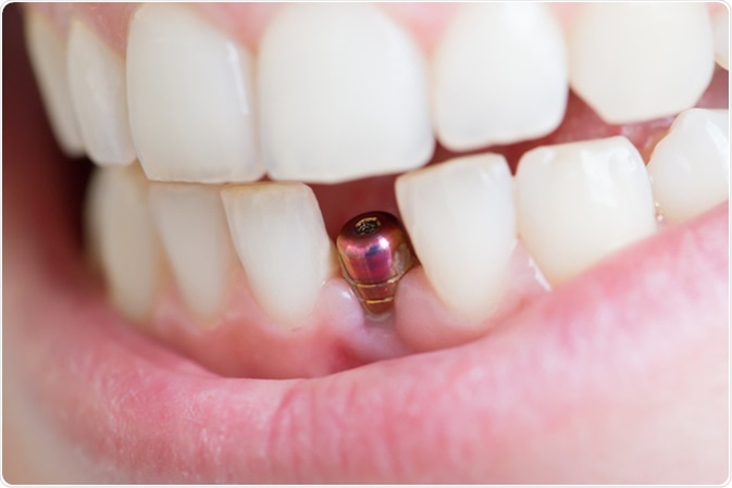 Image result for dental implant 