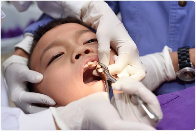 Tooth Extraction - Dental Office & Services in Cinco Ranch, Texas