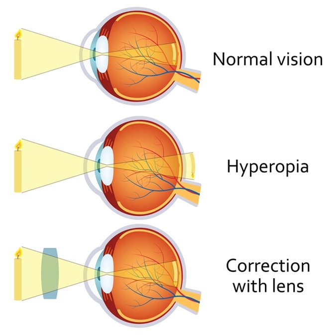 Hyperopia kor torna a szem számára