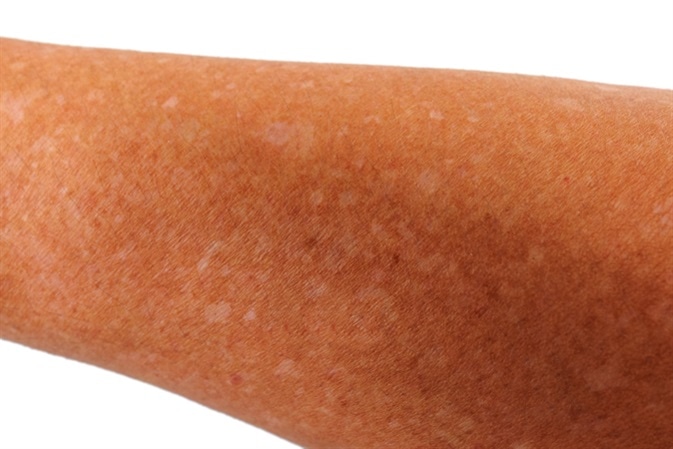 Weiße Flecken erscheinen auf der Haut aufgrund einer idiopathischen Guttata-Hypomelanose.