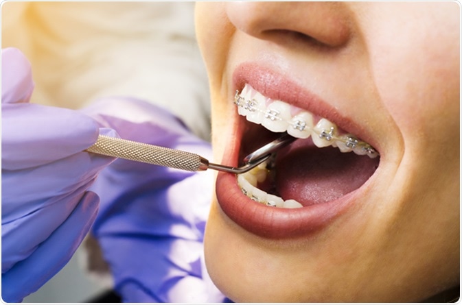 Procedure for Dental Braces