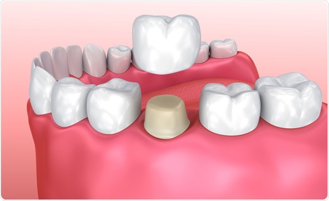 dental crown 