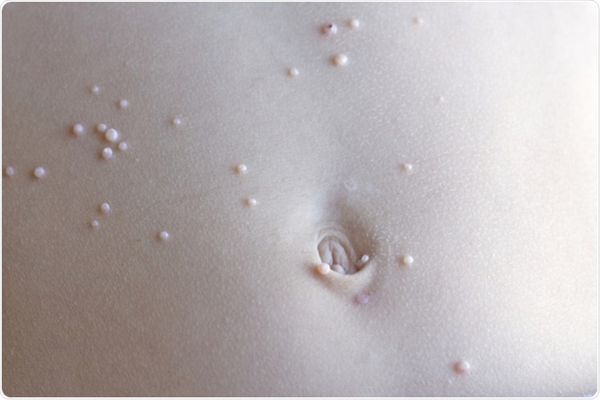 szemölcsök és molluscum contagiosum)