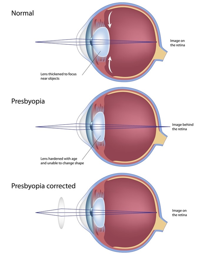 Az öregszeműség tünetei és kezelése (presbyopia)