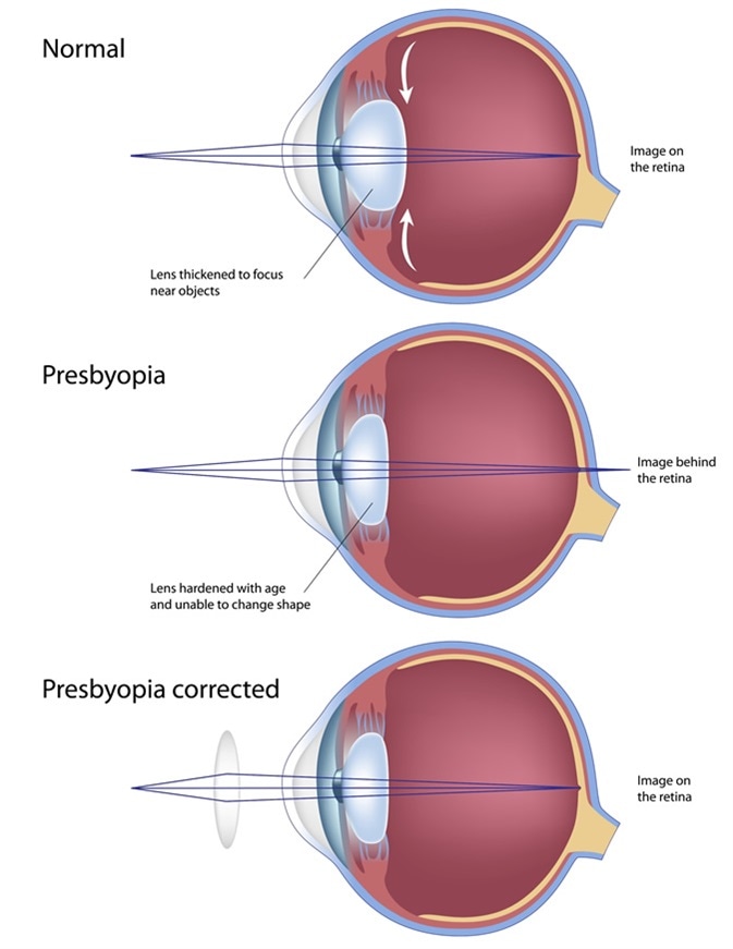 hyperopia presbyopia