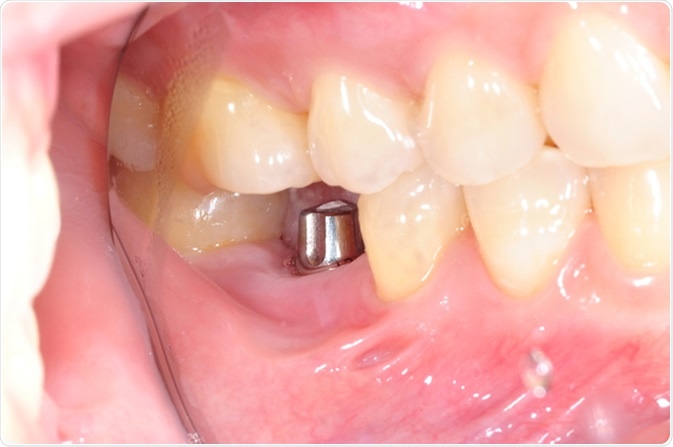 dental implants