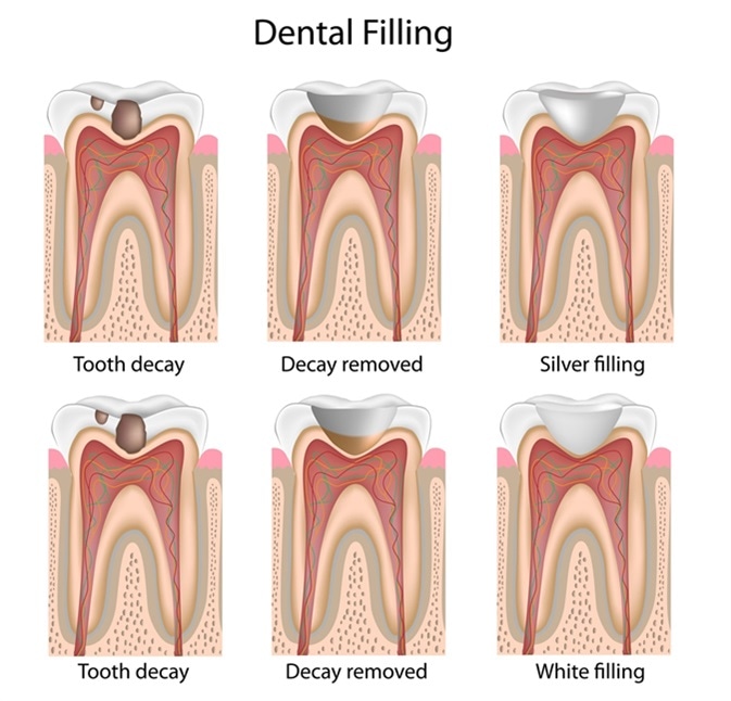Hole white tooth Tooth Cavities: