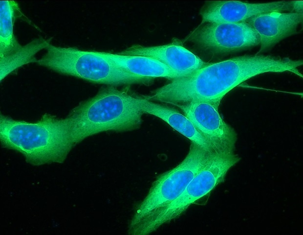 New method can help detect melanoma cells in skin tumors New method can help detect melanoma cells in skin tumors