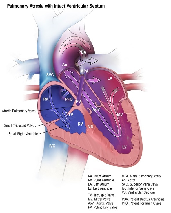 Pulmonary Atresia Diagram - Image Credit: Centers for Disease Control and Prevention, National Center on Birth Defects and Developmental Disabilities) - https://www.cdc.gov/ncbddd/heartdefects/pulmonaryatresia.html