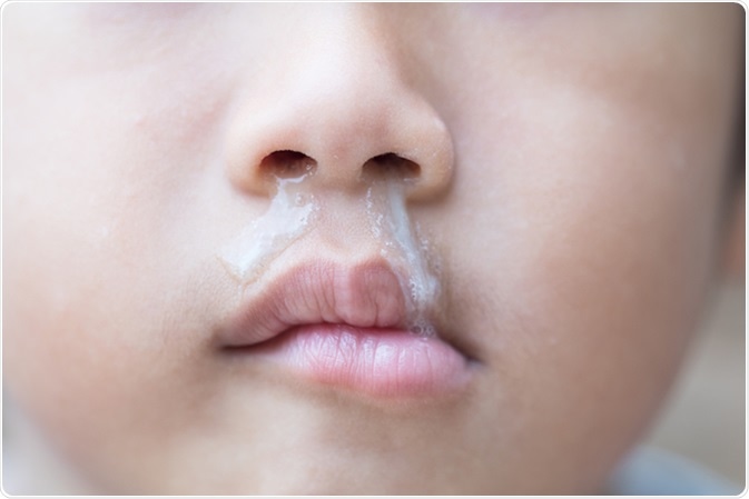 Rhinorrhea or rhinorrhoea is a condition where the nasal cavity is filled with a significant amount of mucus fluid. Image Credit: Treetree / Shutterstock