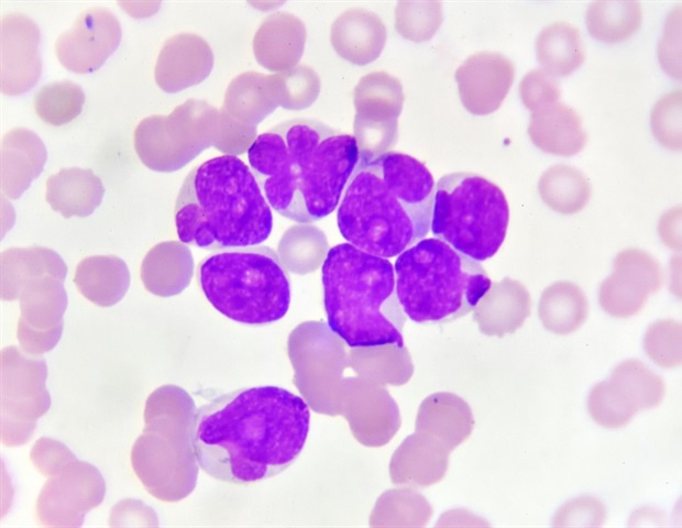 Study provides most detailed classification of acute myeloid leukemia, myelodysplastic syndrome