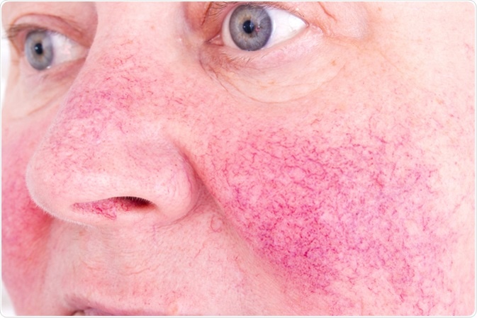 Rosacea characterized by facial redness, small and superficial dilated blood vessels. Image Credit: Lipowski Milan / Shutterstock