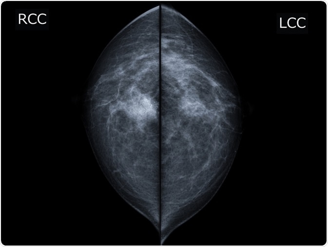 X-ray mammogram image of breast with cancer. - breast cancer of right breast. Image Credit: MossStudio / Shutterstock