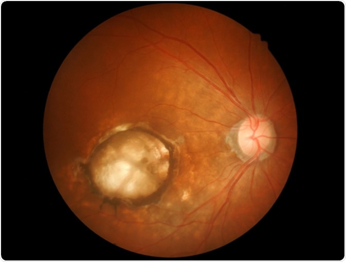 Age-related macular degeneration (AMD) - Image Credit: memorisz / Shutterstock Age-related macular degeneration (AMD) - Image Credit: memorisz / Shutterstock