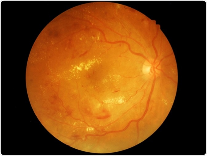 Diabetic Retinopathy - Image Credit: memorisz / Shutterstock Diabetic Retinopathy - Image Credit: memorisz / Shutterstock