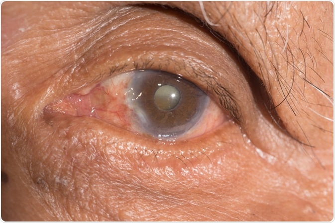 Close up of cataract - Image Credit: ARZTSAMUI / Shutterstock Close up of cataract - Image Credit: ARZTSAMUI / Shutterstock