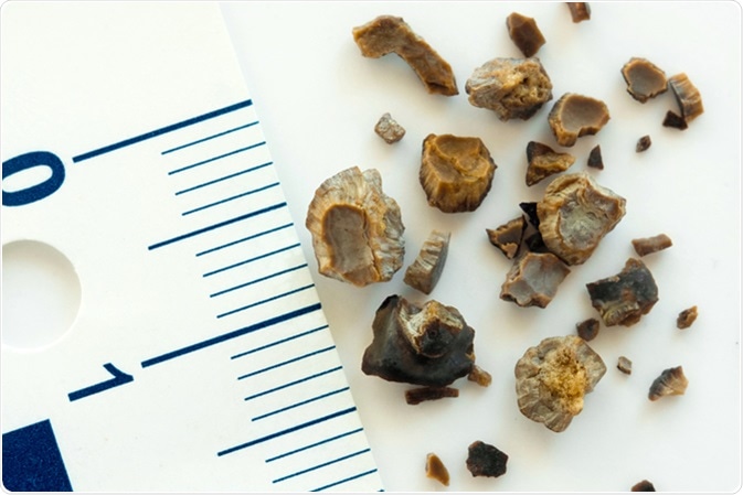 Kidney stones after ESWL intervention. Lithotripsy. image Credit: Evan Lorne / Shutterstock