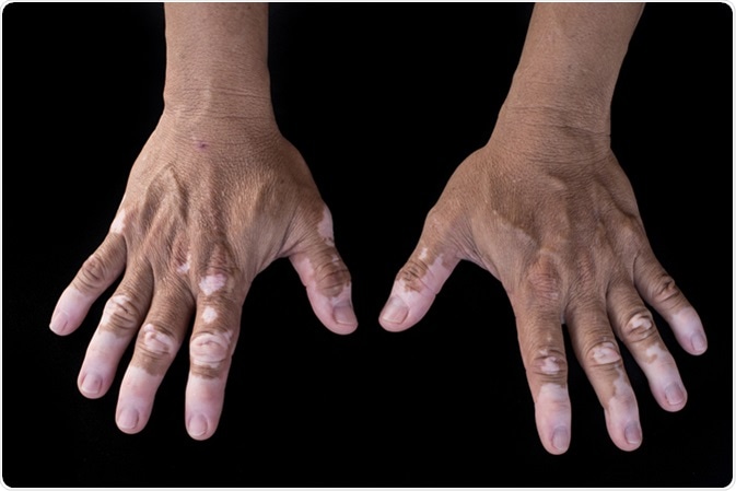 Quadrichrome vitiligo is another variant of vitiligo (on hand). Image Credit: Anon.P / Shutterstock