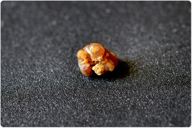 Nephrolithiasis - Closeup shot of a kidney stone (renal calculus or nephrolith). Image Credit: AjayTvm / Shutterstock