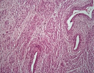 Recurrent Miscarriage Causes