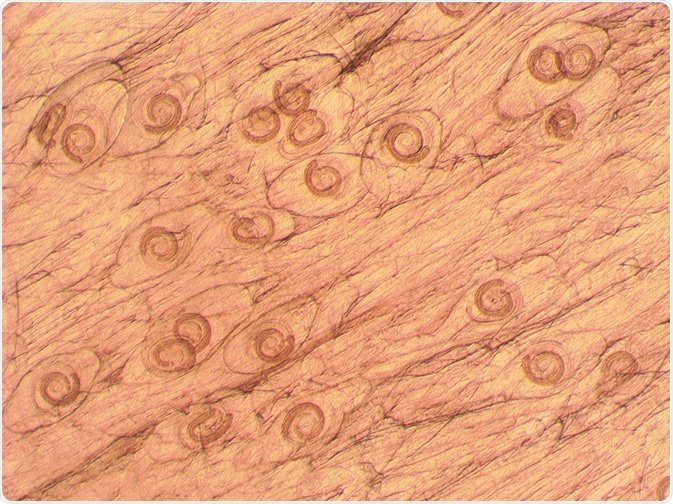 Trichinosis laboratóriumi diagnózis