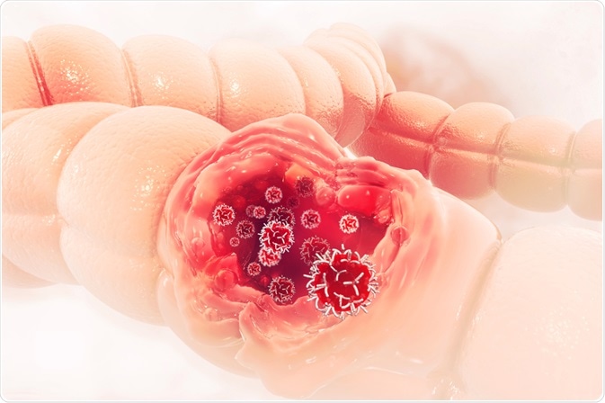 cancer of sarcoma