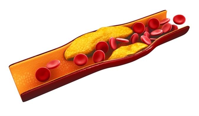 3d Illustration of blood cells with plaque buildup of cholesterol. Image Credit: Victor Josan / Shutterstock
