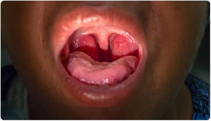 Giardiasis tonsillitis