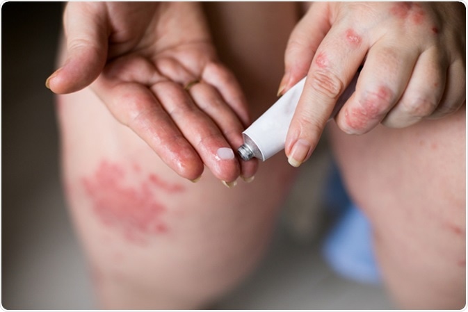 Woodruff, Sweet Natural psoriasis treatment during pregnancy