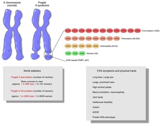 Fragile X Syndrome Causes Treatment And Diagnosis