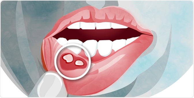 Stomatitis meaning