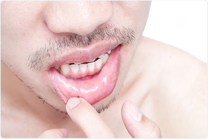 What Is The Difference Between Angular Cheilitis And Herpes Simplex Type 1