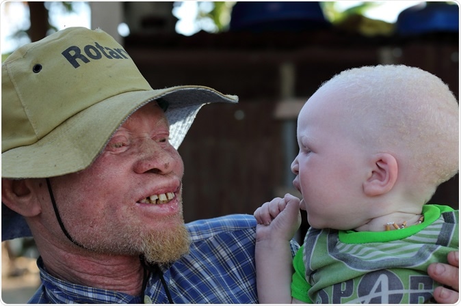 Albinism Causes
