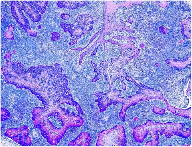 Rous Sarcoma Virus (RSV)