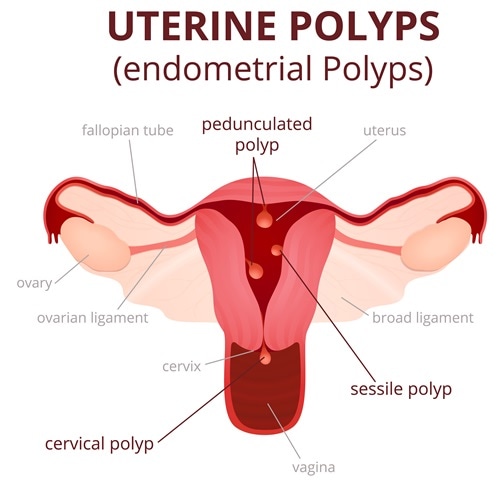 Recurenţa polipilor endometriali – factori de risc şi tratament