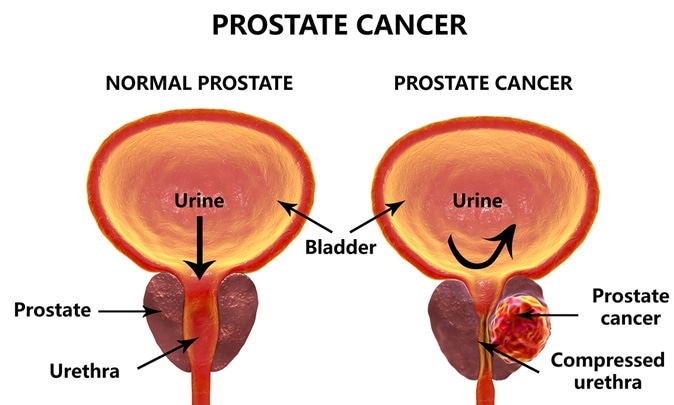 Cancer with benign prostatic hyperplasia. Prostate cancer benign prostatic hyperplasia