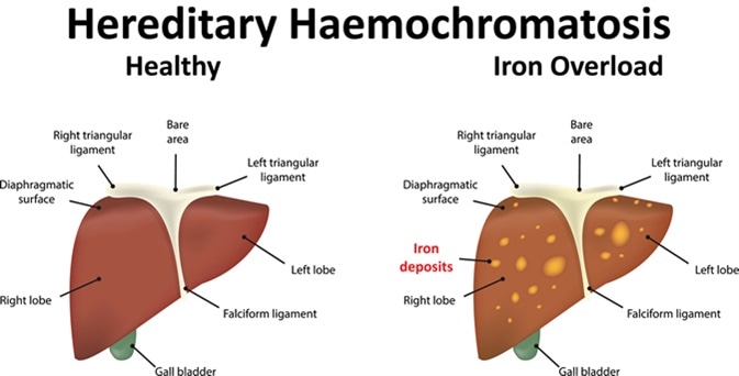 Causes of Hemochromatosis Blood High Iron Levels symptoms