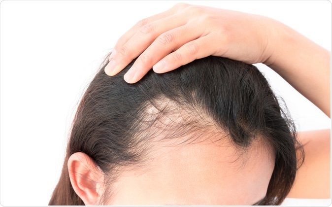 Baldness treatment using a medication for osteoporosis