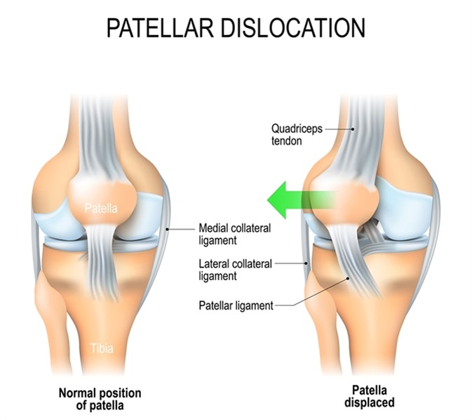 Kneecap Dislocation