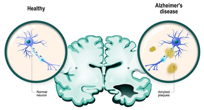 Human brain, in two halves: healthy and Alzheimer