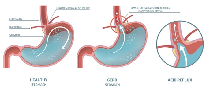 How common is acid reflux in pregnancy