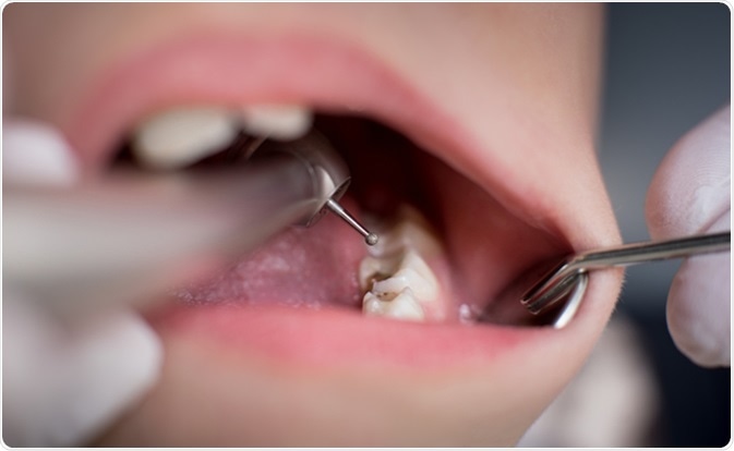 Implant Dentistry – The Convenient and Safe Alternative to Dentures