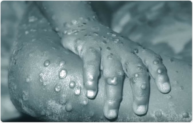 Third case of monkey pox confirmed in UK