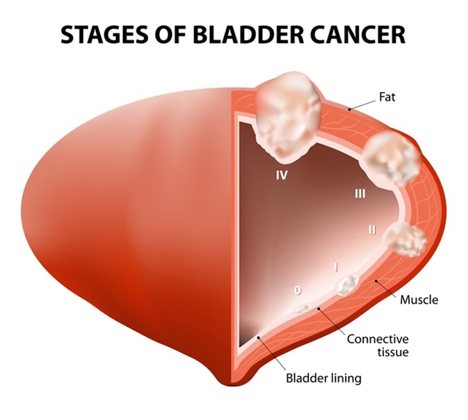 aggressive cancer in bladder