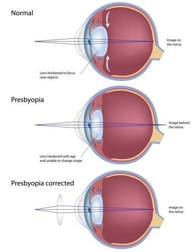 A tompalátás (amblyopia)